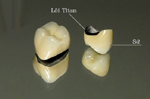 độ bền răng sứ titan